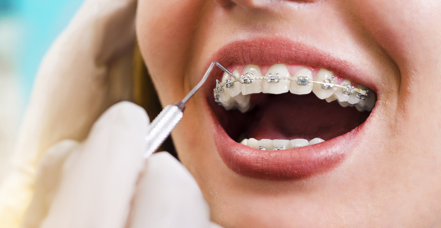 Orthodontics: Functional vs Cosmetic Purposes