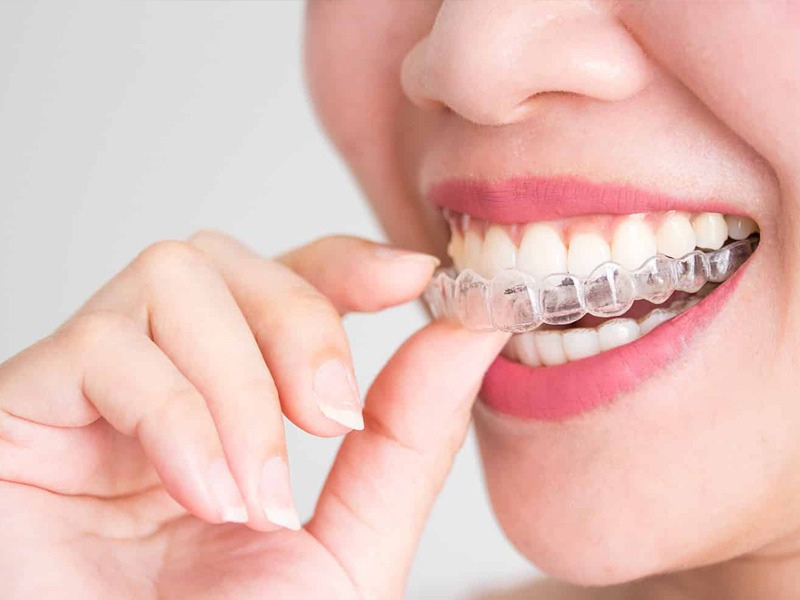 invisalign orthodontic treatment